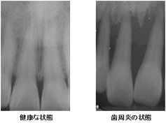 歯周炎のレントゲン写真